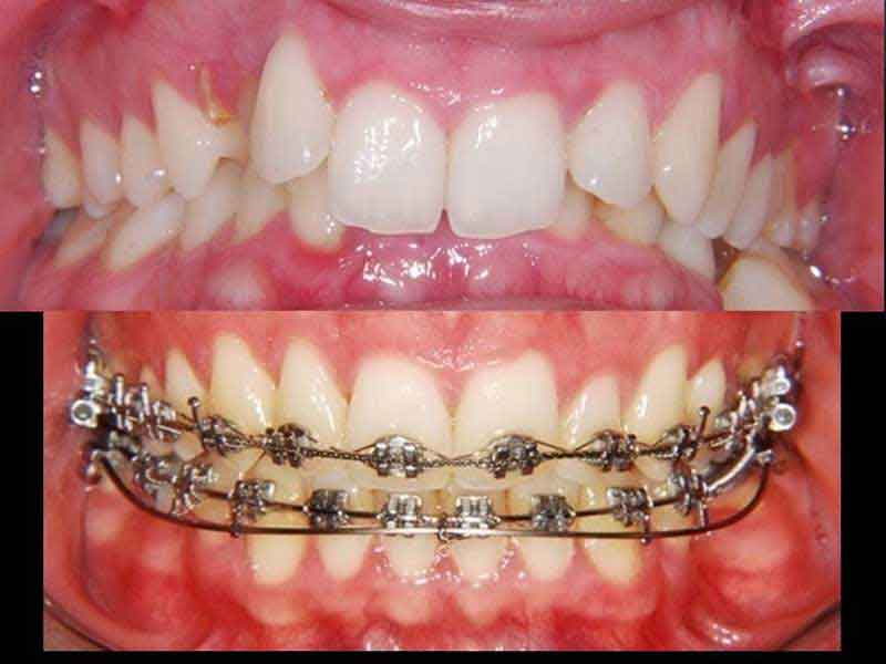 Orthodontic Treatment in Kochi